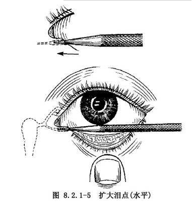 流泪有眼屎的孩子为什么需要冲洗泪道或者泪道探通