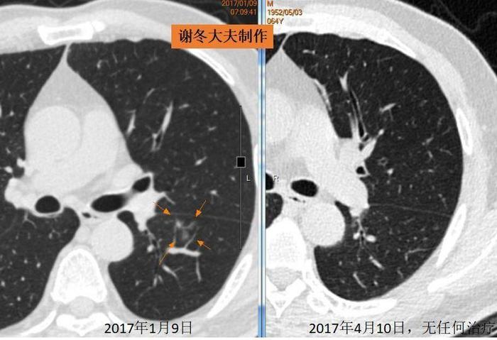 肺磨玻璃结节会消失吗?为什么磨玻璃结节要重