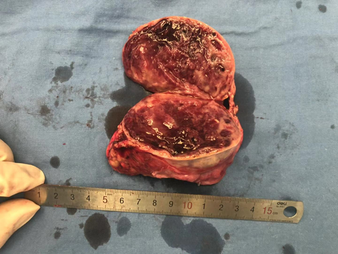 巨大肾上腺嗜铬细胞瘤手术一例
