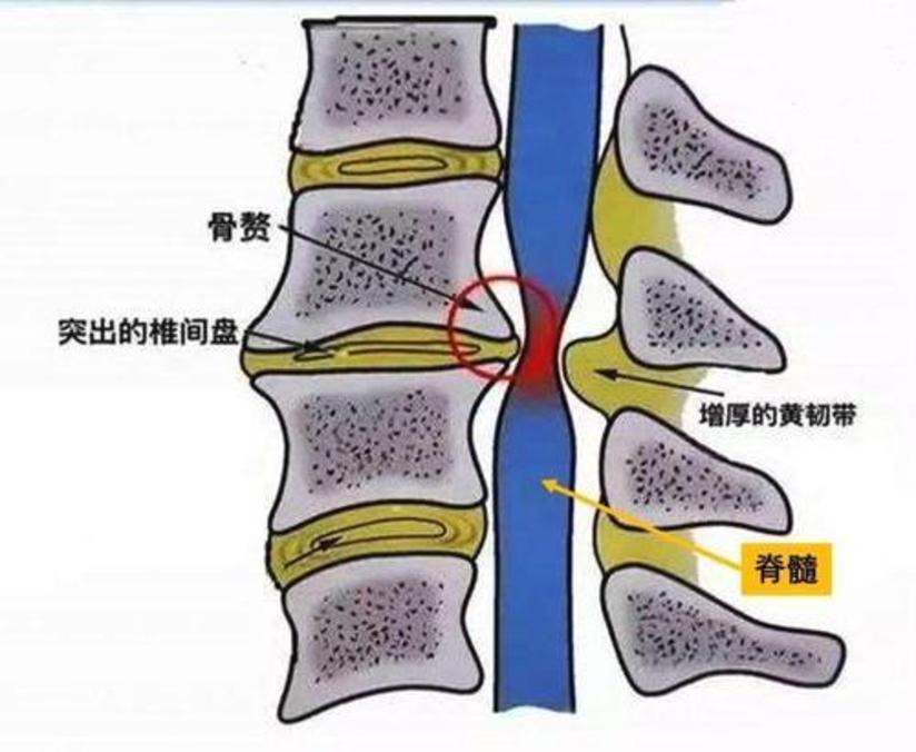 得了脊髓型颈椎病要注意 这类颈椎病需要尽早手术 健康号 微医