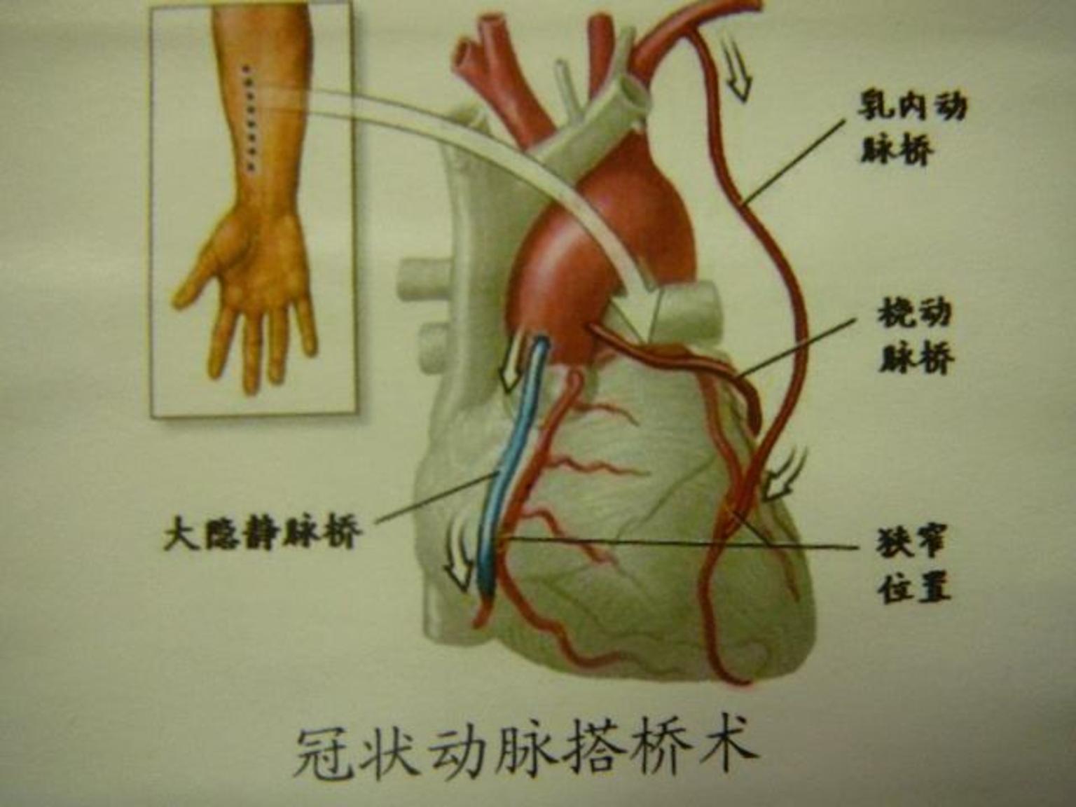 心臟搭橋是怎麼一回事