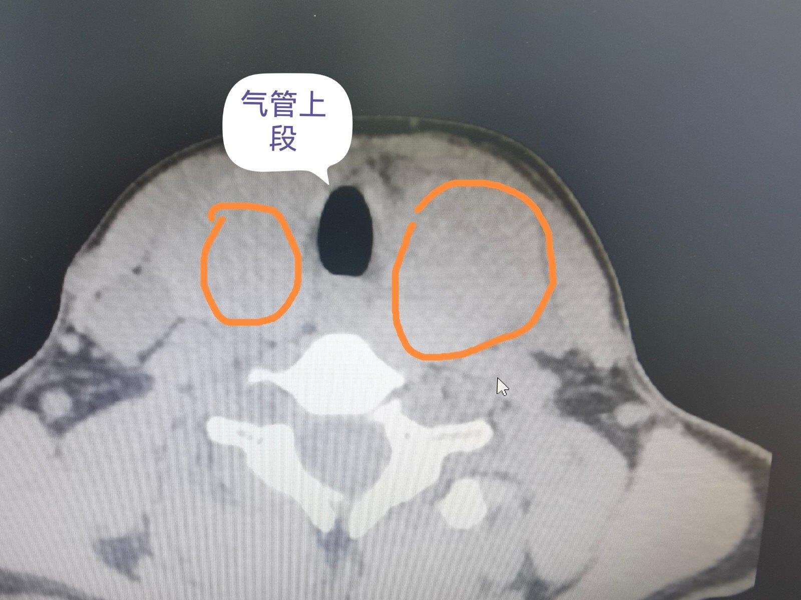良性甲状腺结节对气管的影响