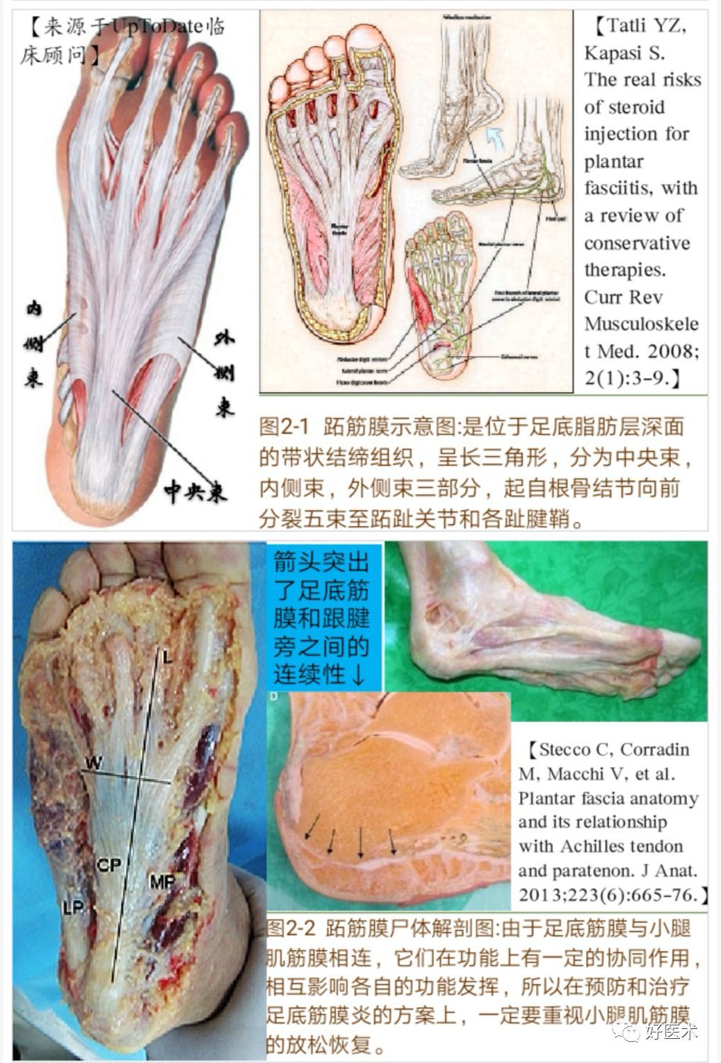 足底筋膜炎解剖图图片