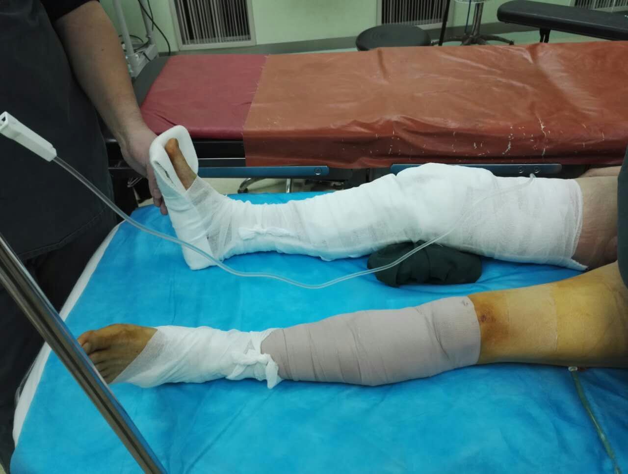 膝关节脱位前后交叉韧带及内侧副韧带损伤一期重建