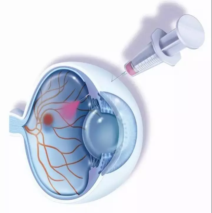 【来自患者的一张小纸条】关于玻璃体腔注射,你可能关心的小问题_李君