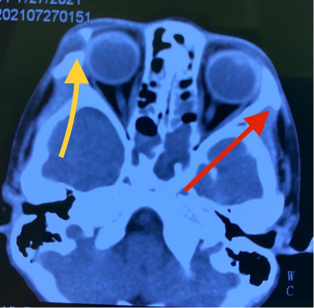外科笔记眼眶肿瘤皮样囊肿之一切除联合一期骨壁重建