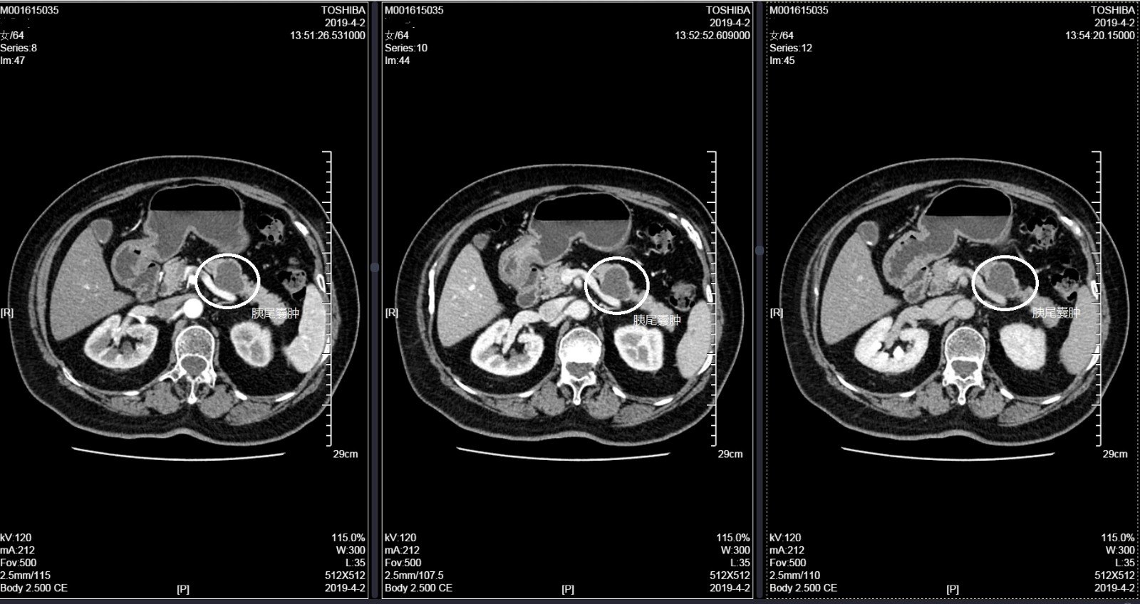 何为胰腺囊腺瘤为什么胰腺粘液性囊腺瘤需要手术浆液性囊腺瘤可以观察