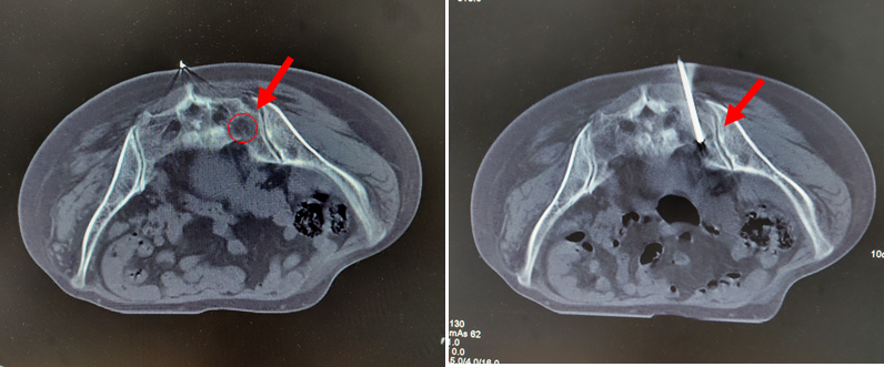 恶性肿瘤骨转移的诊断原则_钱国伟医生文章_上海市第六人民医院-微医