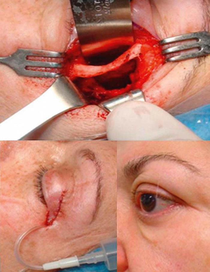 眼眶外壁减压手术,减压范围和切口漫谈!