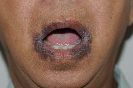 什么样的皮肤黑斑提示胃肠道有息肉