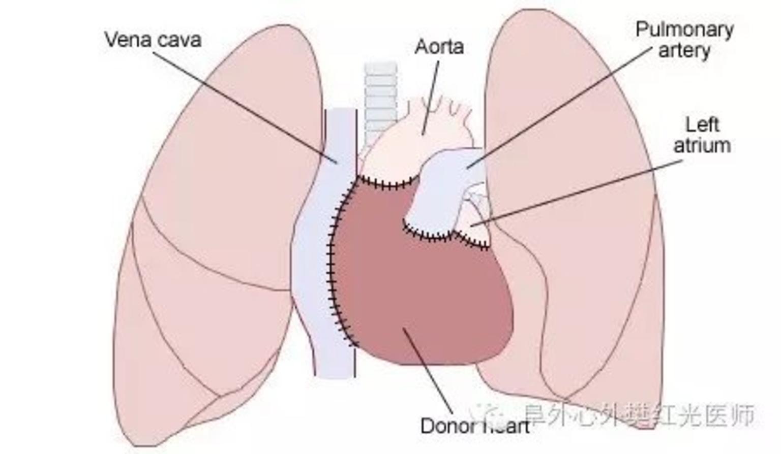 心脏移植的前世今生