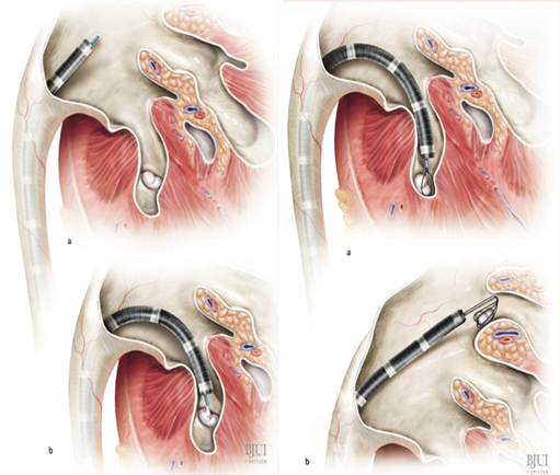 什么是输尿管软镜碎石术