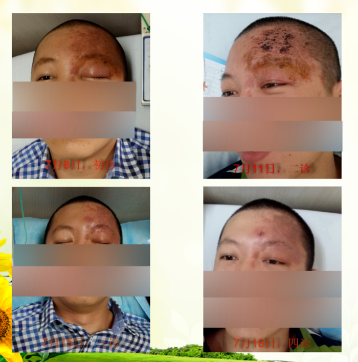 火针治疗带状疱疹及后遗神经痛镇痛止痒修复皮肤破损与感觉缺失