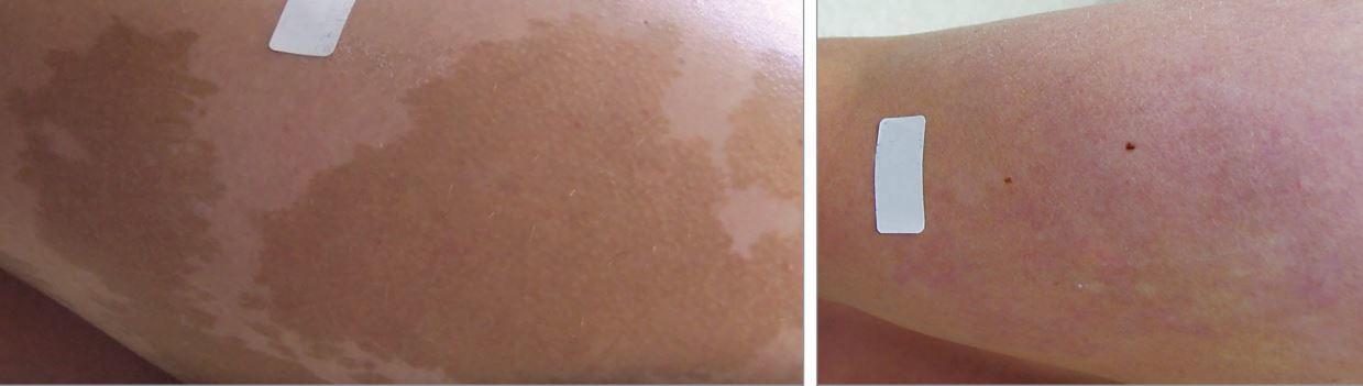 什么样的牛奶咖啡斑容易去除