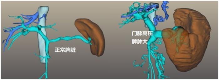 脾大,脾功能亢进门静脉高压有什么表现其他病因有门静脉血栓形成,门