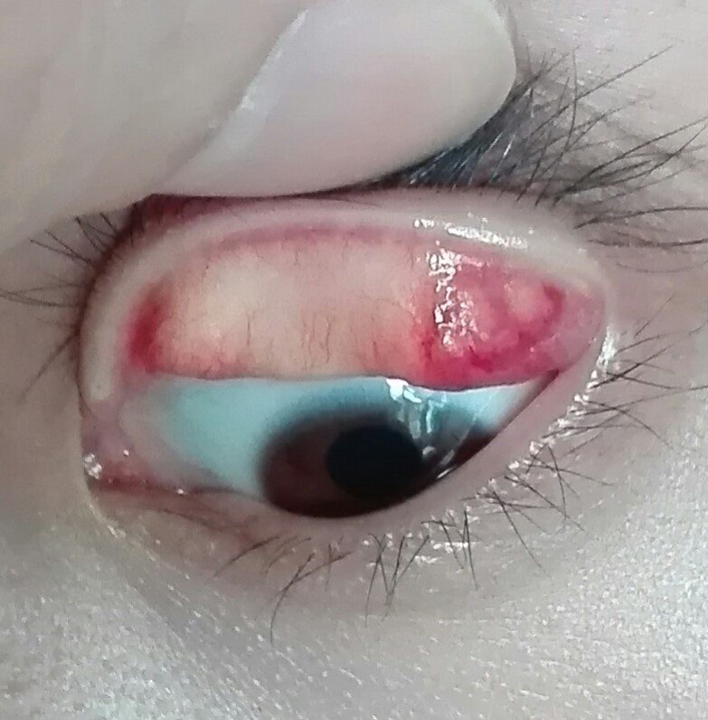 极小的霰粒肿无需治疗.大者多数需手术治疗,手术最佳时机为破溃前.