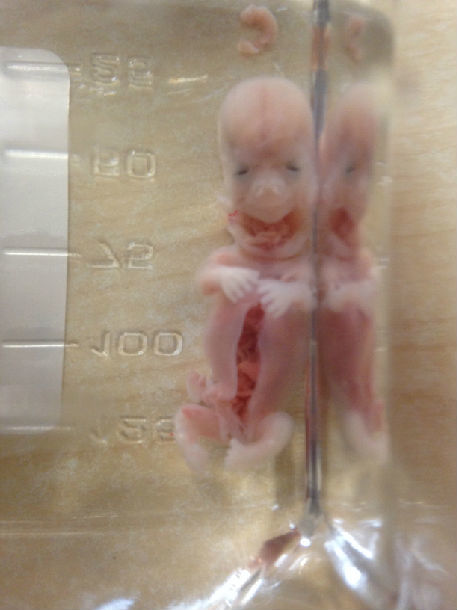 四十天人流后胎儿图片图片