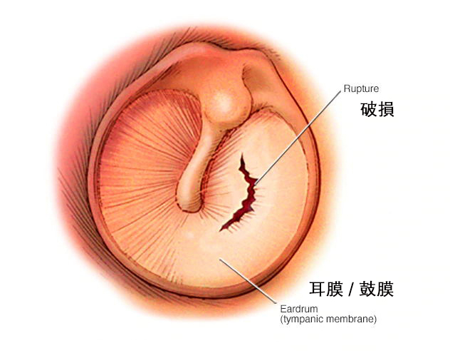 鼓膜穿孔了该怎么办