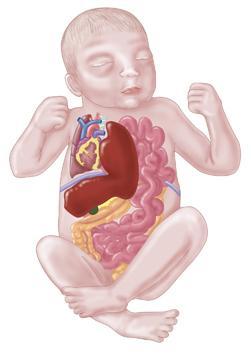 先天性膈疝高风险的出生缺陷