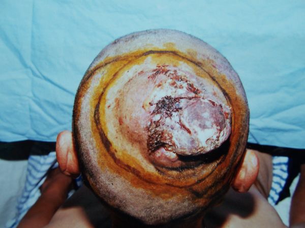 皮肤癌的表现,诊断与治疗