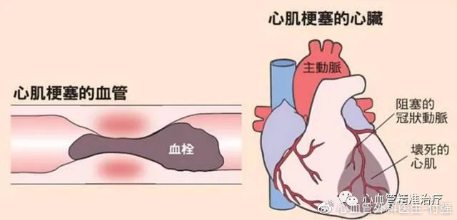 心肌梗塞是怎么发生的有哪些高危险人群
