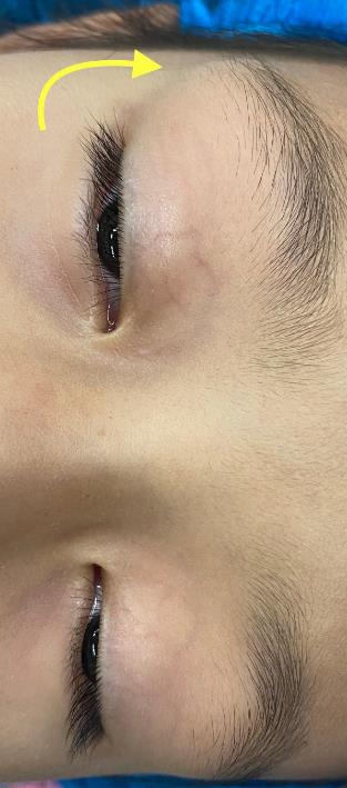 外科笔记眼眶肿瘤皮样囊肿之一切除联合一期骨壁重建