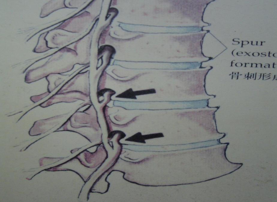 腰椎侧隐窝性疼痛解剖病因与诊治