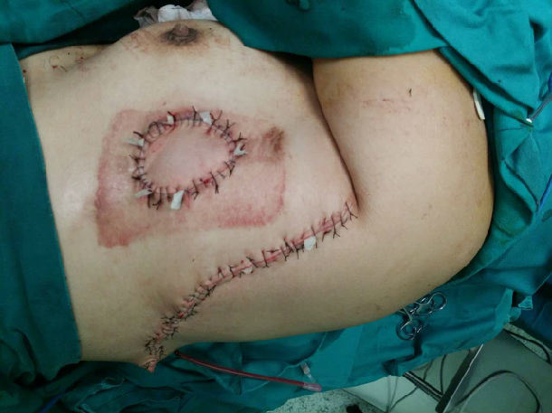 心脏手术后胸部慢性窦道并感染