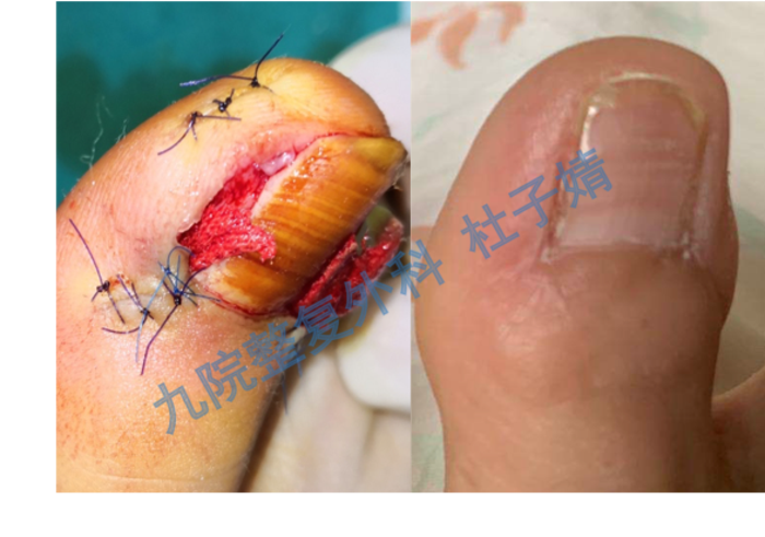 3,手术注意事项甲沟炎根治术,行甲根部分切除,可同时行甲沟成形术,术