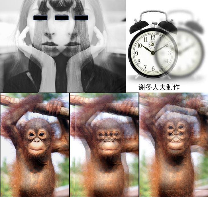 下图是典型复视的表现典型的眼睑下垂眼睑下垂,视物重影等,在发病初期