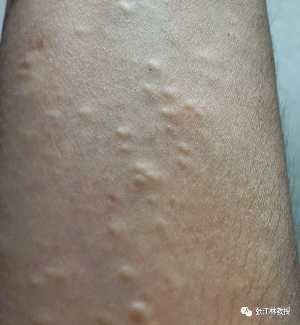 皮脂腺囊肿成因和治疗 - 微医(挂号网)