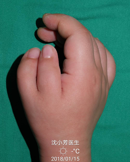 桡侧多指复拇畸形的常见分型及治疗