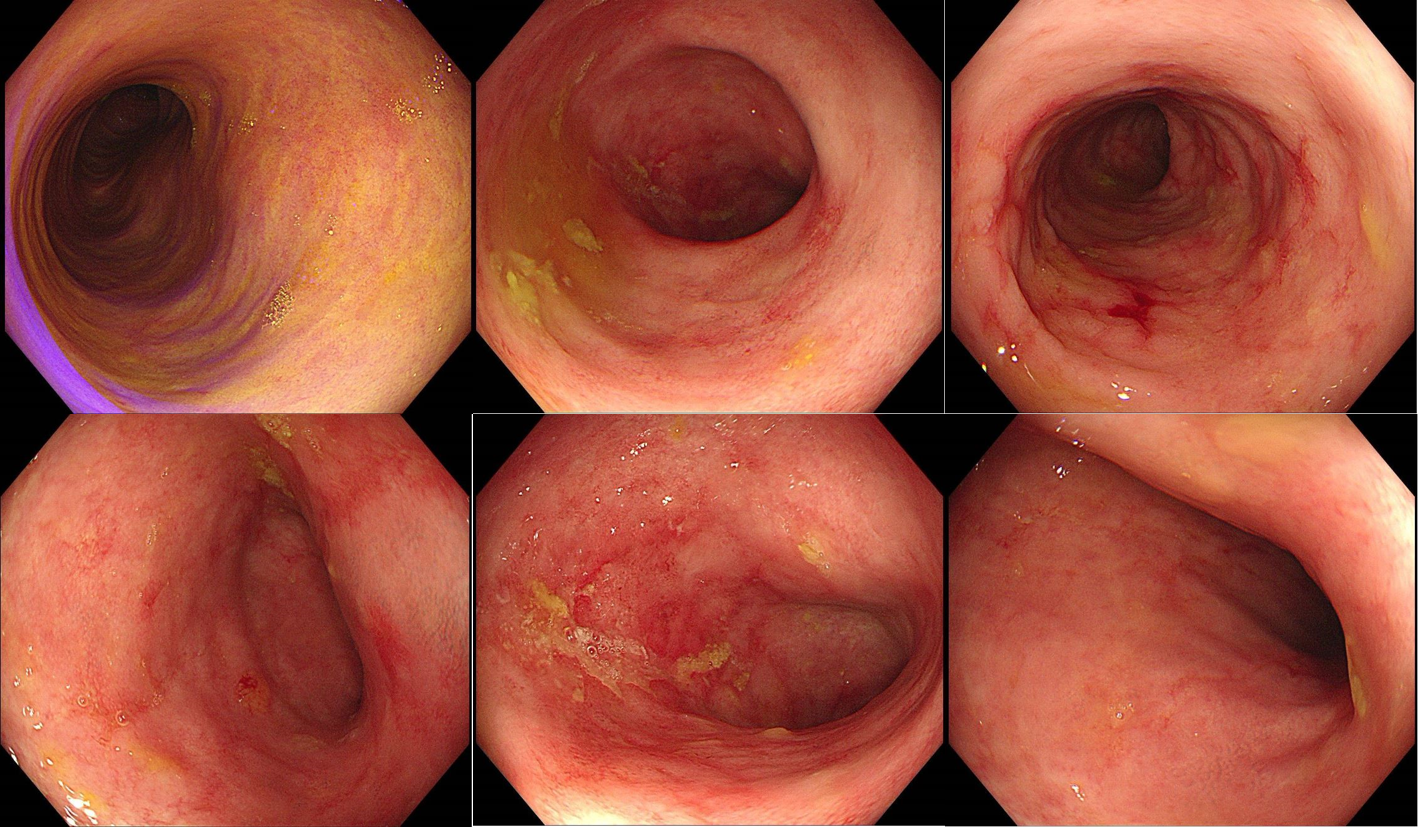 图4 治疗后肠镜于10月至我处复查肠镜:乙状结肠中上段,直肠上段部分