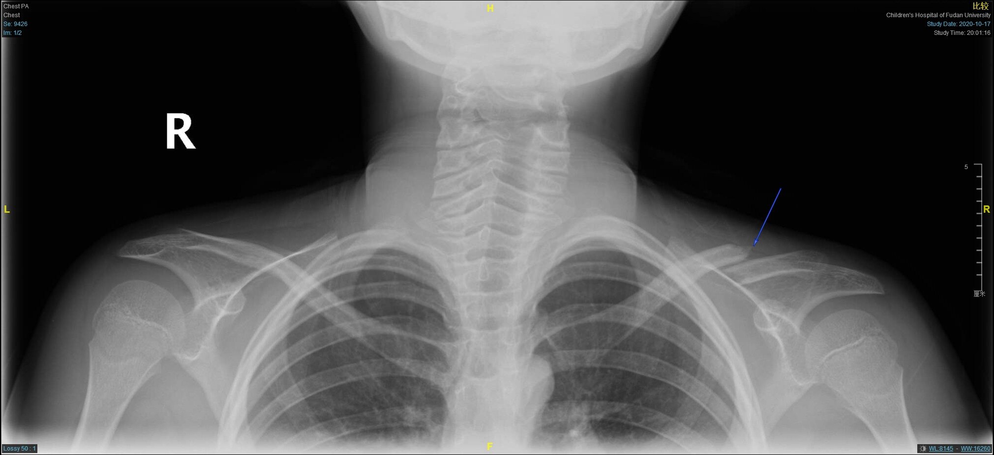 儿童锁骨骨折手术治疗(大于12岁)