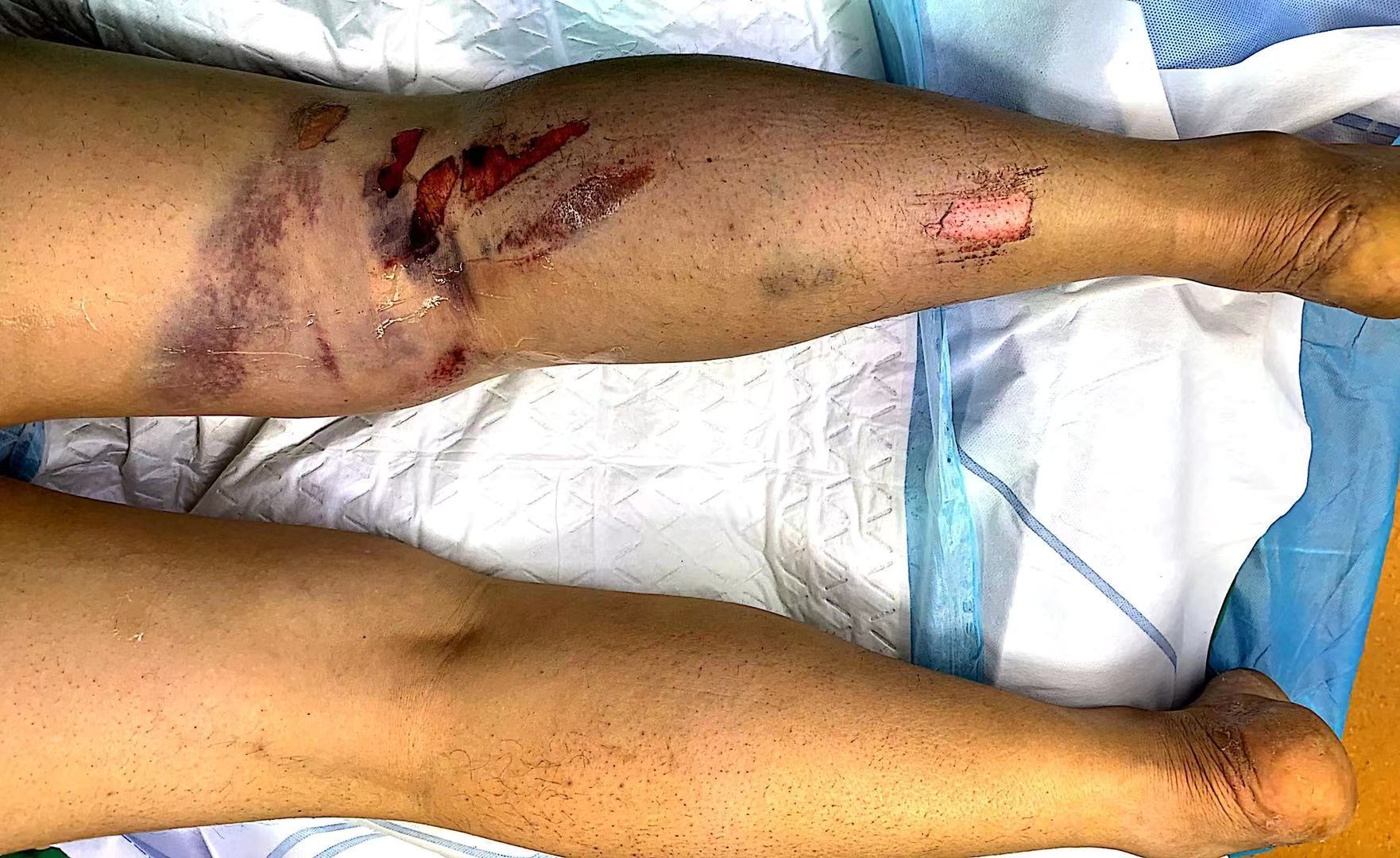 带你了解骨科急症中致命性损伤之一腘血管损伤的那些事儿