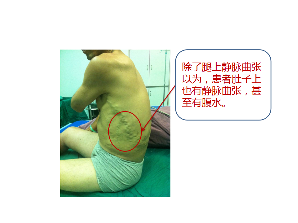 下肢静脉曲张复发了该怎么办