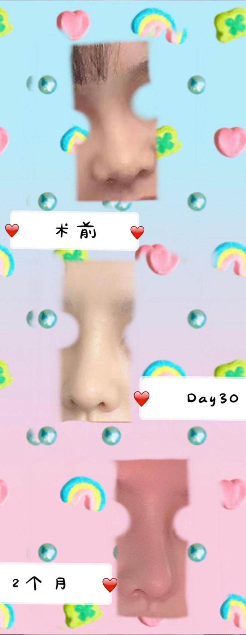 钟爱梅耳软骨鼻综合案例分享 健康号 微医