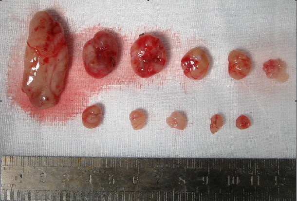 椎管内多发性神经鞘瘤一例报告及文献复习以往发表论文