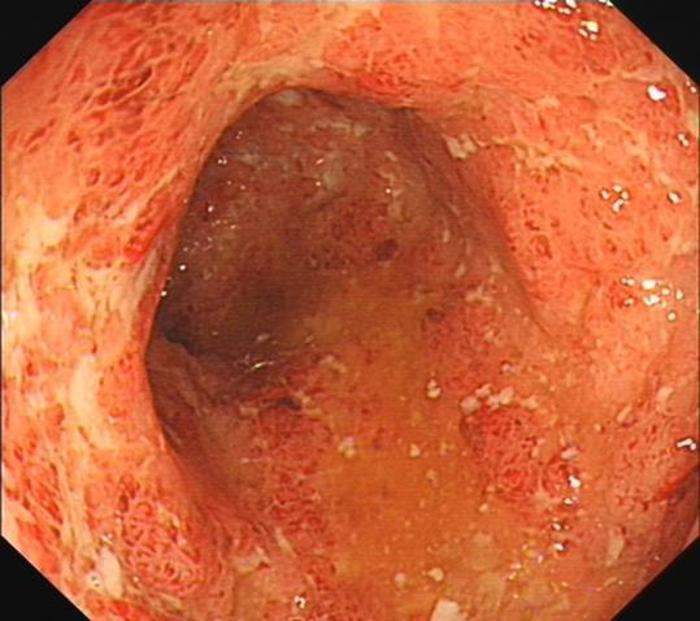 手术严重溃疡性结肠炎的终极治疗选择