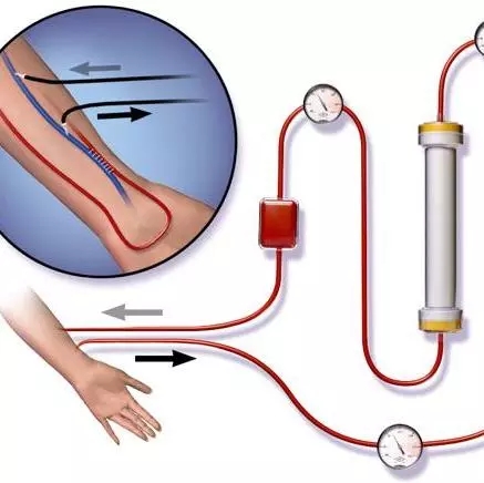 尿毒症后,必须要考虑的腹透vs血透,哪个更好?文末有必读内容