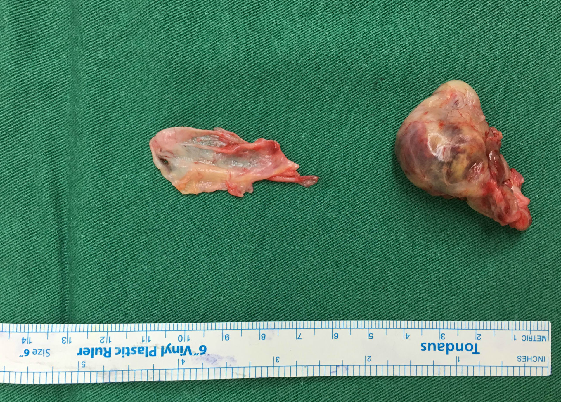 典型病例外周神经鞘瘤