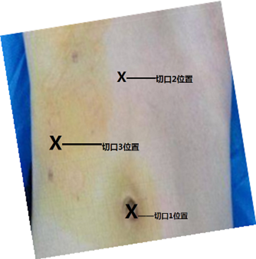 B超发现胆囊息肉怎么办 得了胆囊息肉需要手术不 兰大二院就医流程指导 健康号 微医
