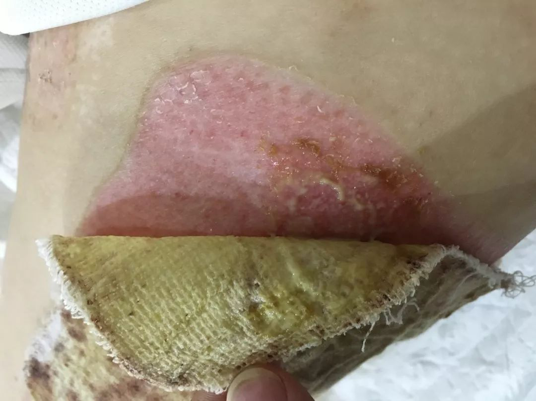 烫伤后有没有不用换药的治疗方案?