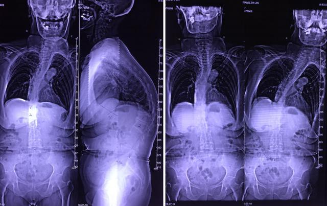 骨质疏松症(t=-2.6)3. 腰椎间盘突出症(l3/4,l4/5)4.