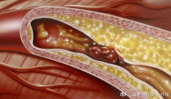 坚持做这几件事让血管堵塞远离中老年人