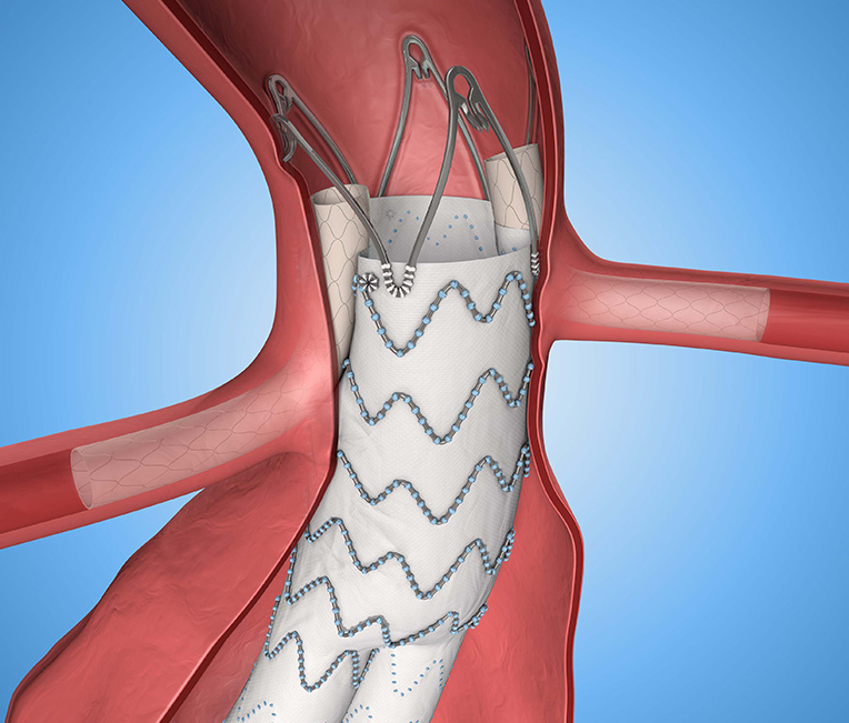 在 evar 过程中,动脉瘤保持完整,通过导管置入支架移植物改变血流路线