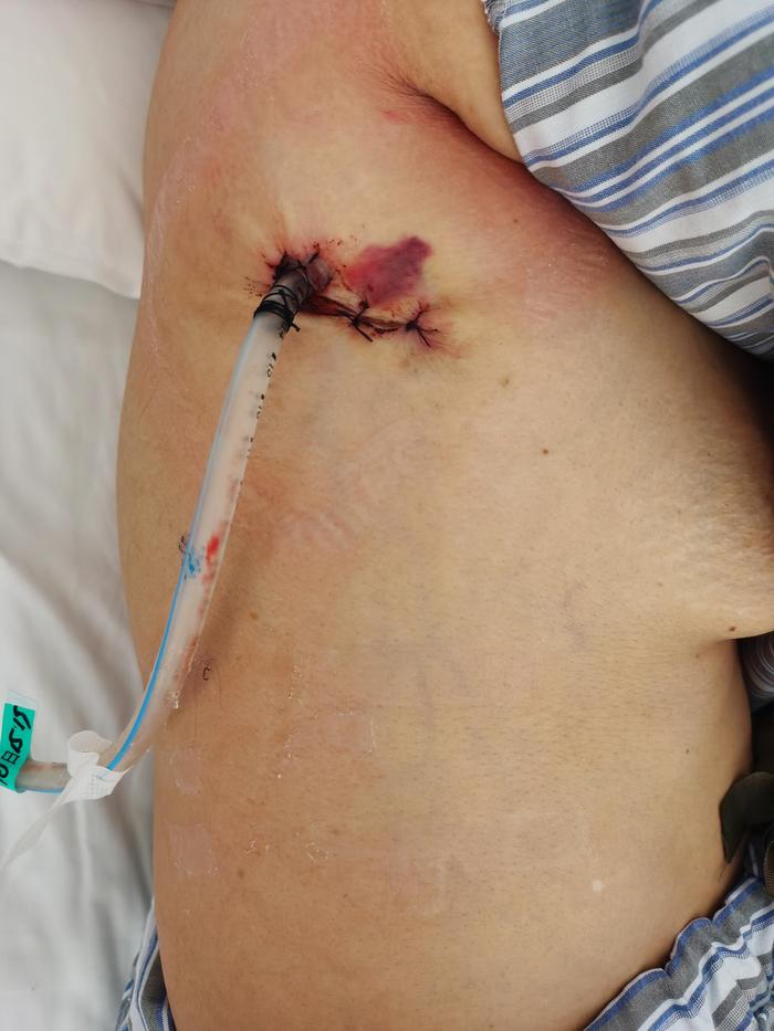 现在气胸采用胸腔镜微创手术,一个3cm的切口就能完成手术操作