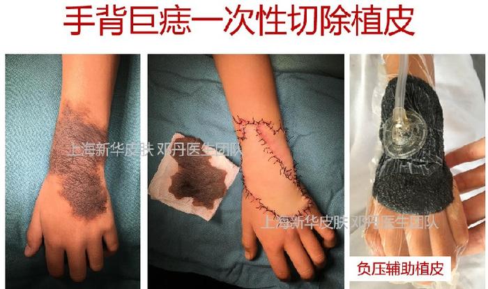 病例系列03手背巨大兽皮痣全切植皮