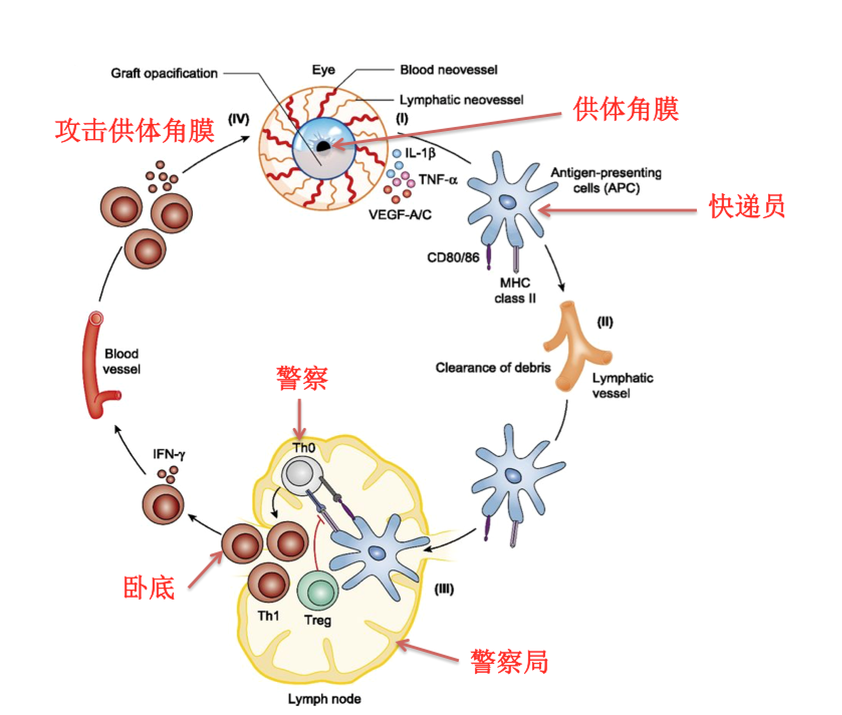 角膜移植后免疫排斥的蛛丝马迹
