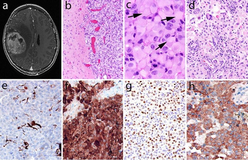2016年who胶质母细胞瘤分类解读